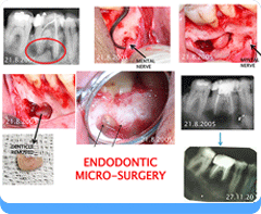 Surgical Endodontics - Apicoectomy, Hemisectom, Radisectomyy, Bicuspidizationt
