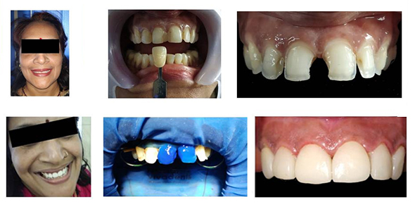 Smile Designing with Ceramic Veneer